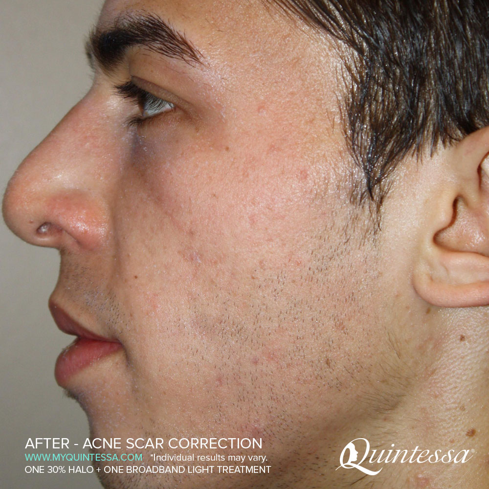 BBL Laser Treatment After Acne Scar Correction