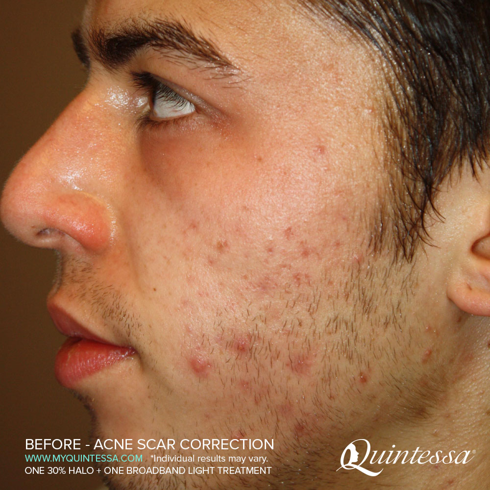 BBL Laser Treatment Before Acne Scar Correction