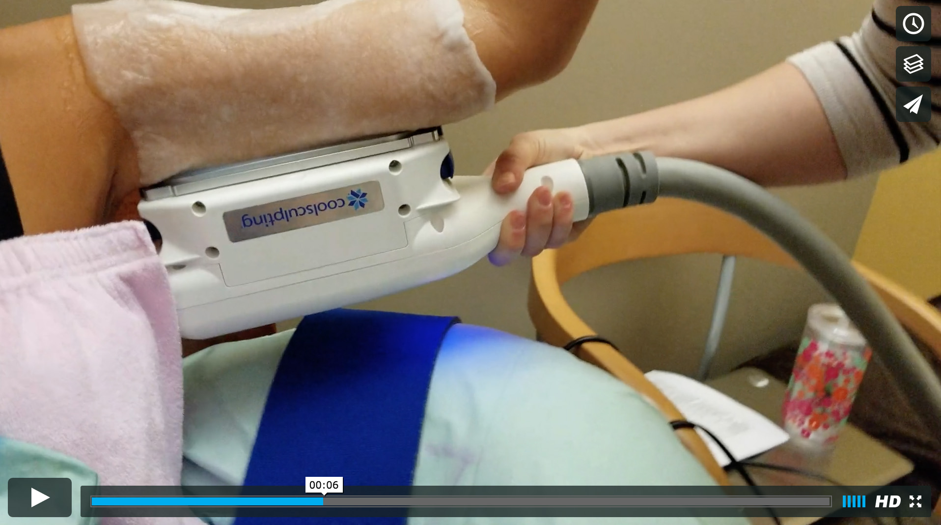 a patient undergoes coolsculpting for their underarm