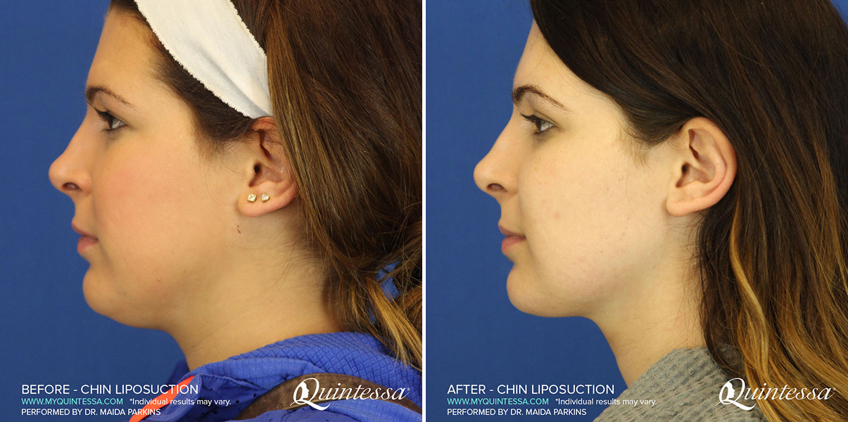Chin Augmentation Before and After Photos in Madison, WI, Patient 17288