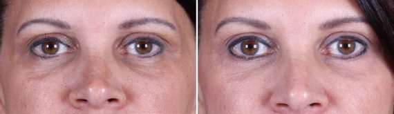 Eyelid Surgery Before and After Photos in Delafield, WI, Patient 17297