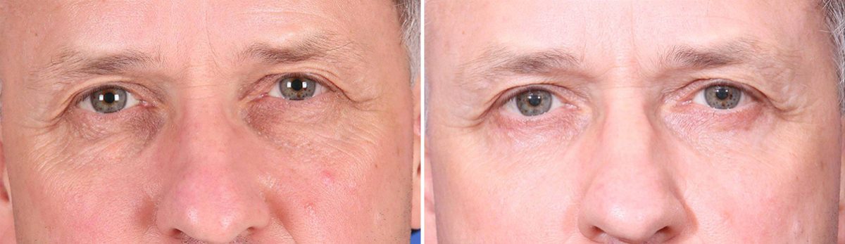 Eyelid Surgery Before and After Photos in Delafield, WI, Patient 17302