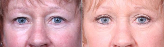 Eyelid Surgery Before and After Photos in Delafield, WI, Patient 17306