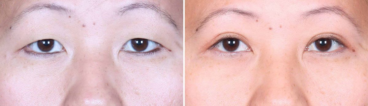 Eyelid Surgery Before and After Photos in Delafield, WI, Patient 17310
