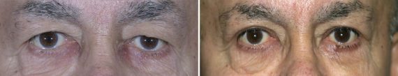 Eyelid Surgery Before and After Photos in Delafield, WI, Patient 17314
