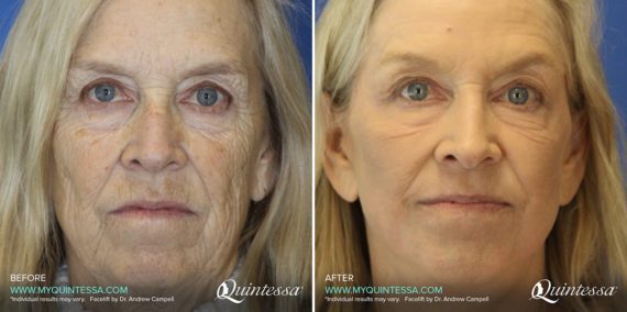 Facelift Before and After Photos in Madison, WI, Patient 17319