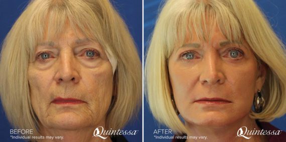 Facelift Before and After Photos in Madison, WI, Patient 17323