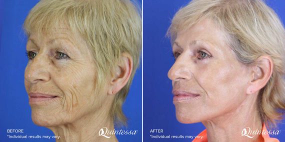Facial Fat Grafting Before and After Photos in Madison, WI, Patient 17328