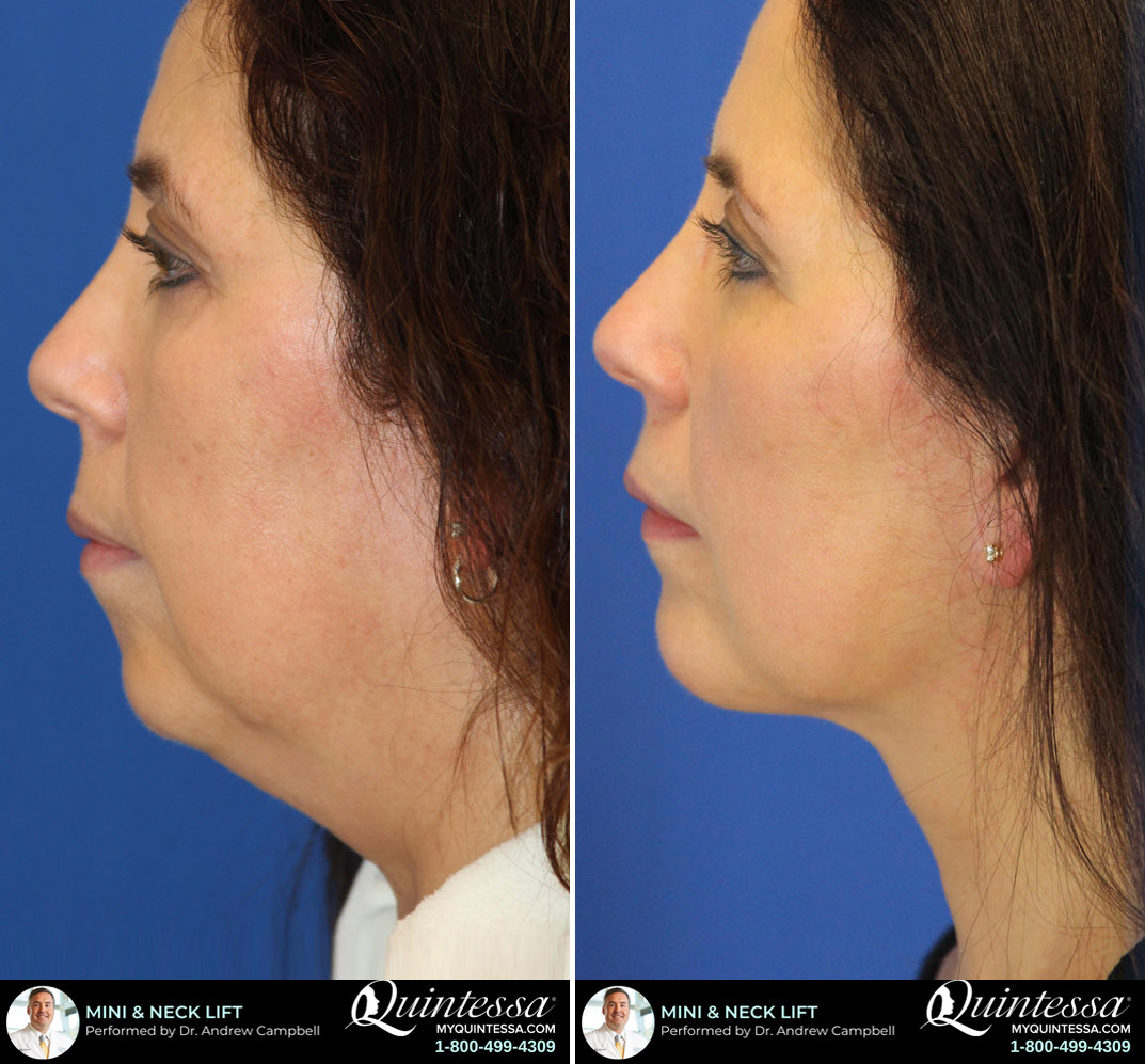 Mini Facelift Before and After Photos in Delafield, WI, Patient 17332