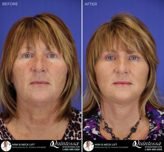 Mini Facelift Before and After Photos in Delafield, WI, Patient 17336
