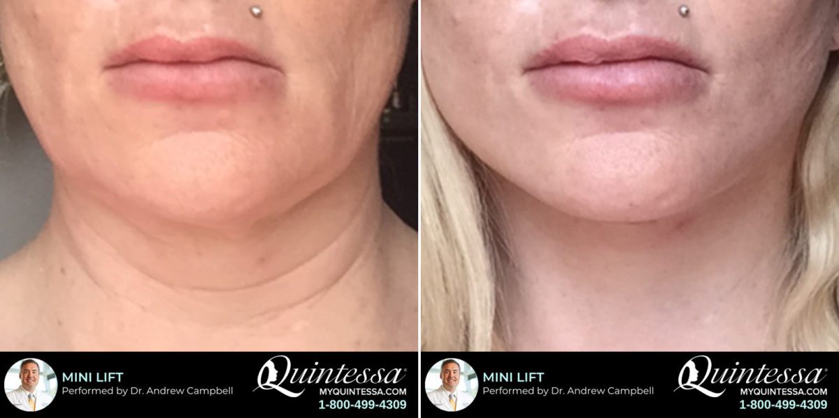 Mini Facelift Before and After Photos in Delafield, WI, Patient 17340
