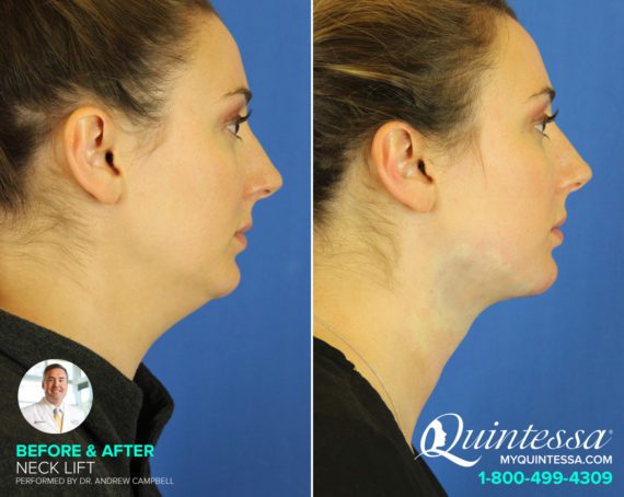 Neck Lift Before and After Photos in Delafield, WI, Patient 17355