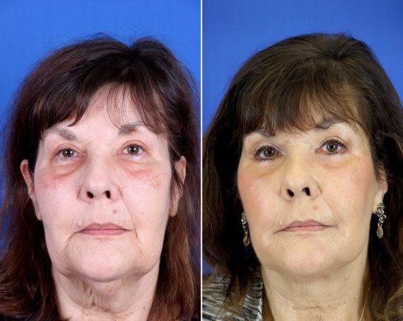 Neck Lift Before and After Photos in Delafield, WI, Patient 17359