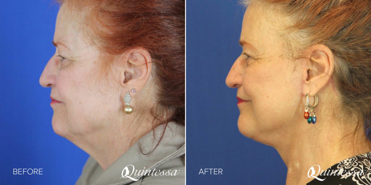 Neck Lift Before and After Photos in Delafield, WI, Patient 17363