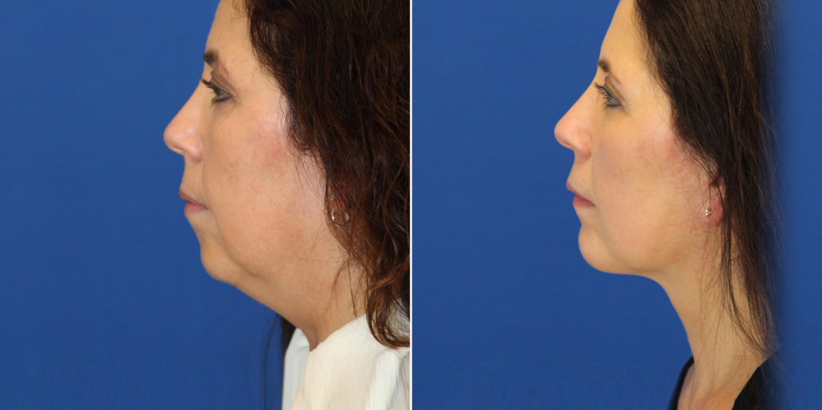 Neck Lift Before and After Photos in Delafield, WI, Patient 17367
