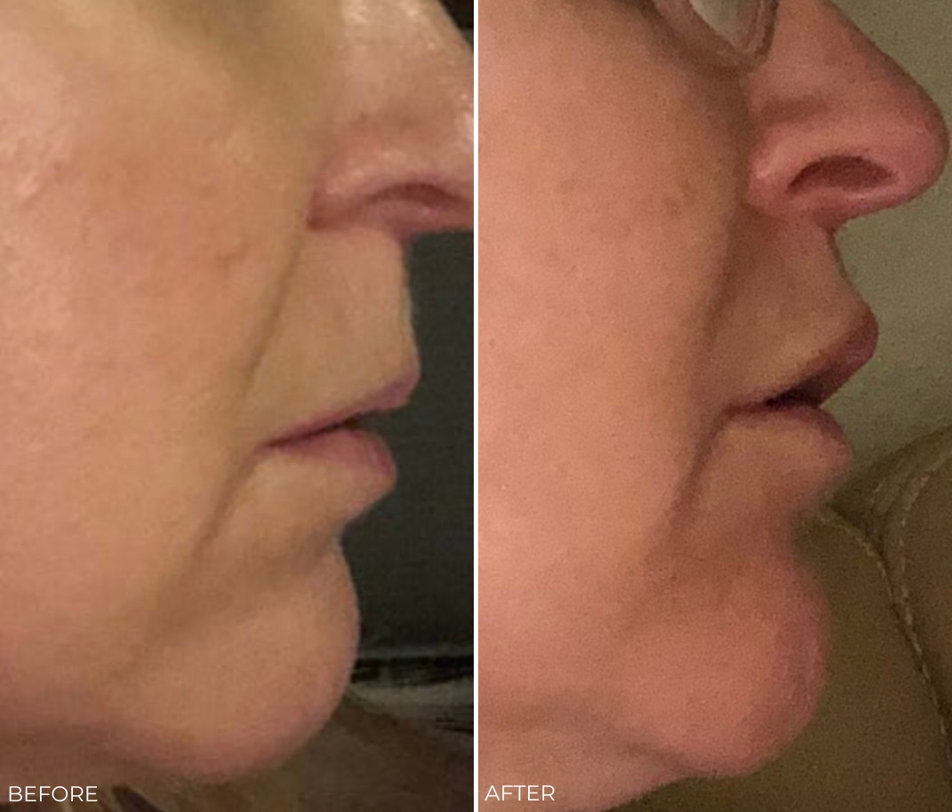 Lip Lift Before and After Photos in Delafield, WI, Patient 17373