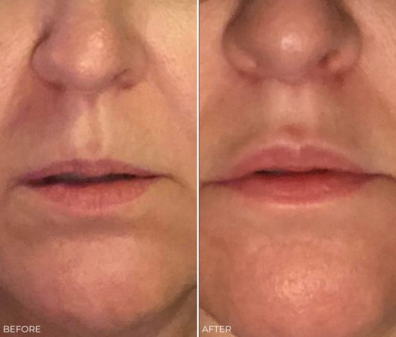 Lip Lift Before and After Photos in Delafield, WI, Patient 17377