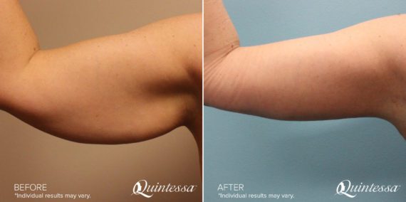 Arm Lift Before and After Photos in Delafield, WI, Patient 17381