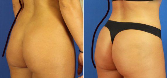 Brazilian Butt Lift Before and After Photos in Delafield, WI, Patient 17386