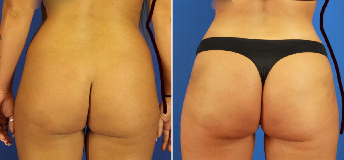 Brazilian Butt Lift Before and After Photos in Delafield, WI, Patient 17386