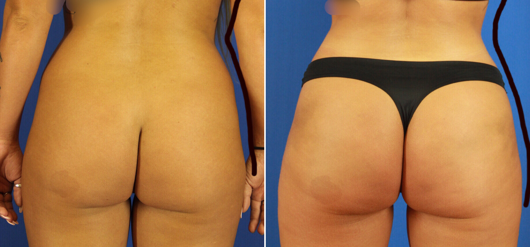 Brazilian Butt Lift Surgery Madison & Milwaukee, Before and After Photo...