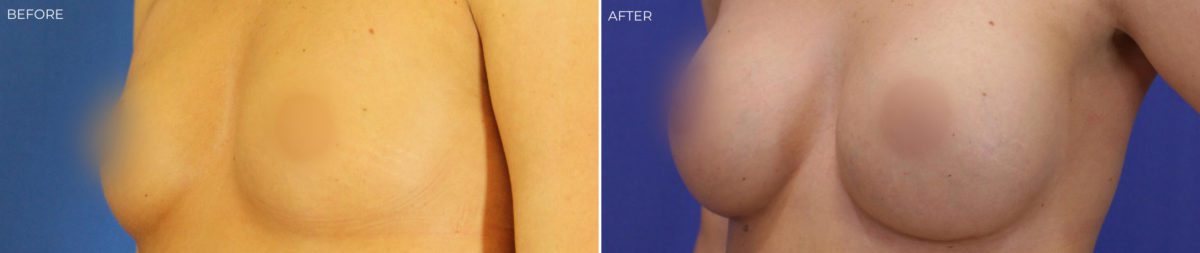 Breast Augmentation Before and After Photos in Delafield, WI, Patient 17394