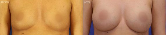 Breast Augmentation Before and After Photos in Delafield, WI, Patient 17394