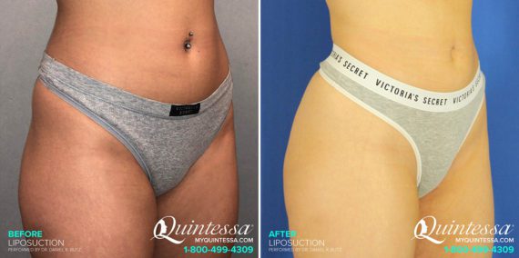 Fat Transfer Before and After Photos in Madison, WI, Patient 17415