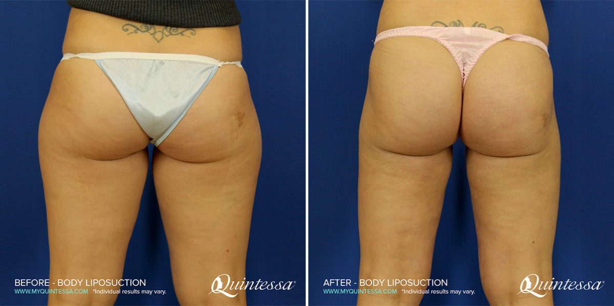 Liposuction Before and After Photos in Delafield, WI, Patient 17419