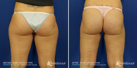 Liposuction Before and After Photos in Delafield, WI, Patient 17419