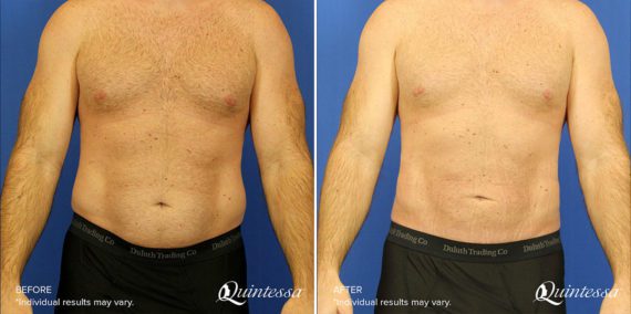 Liposuction Before and After Photos in Delafield, WI, Patient 17423