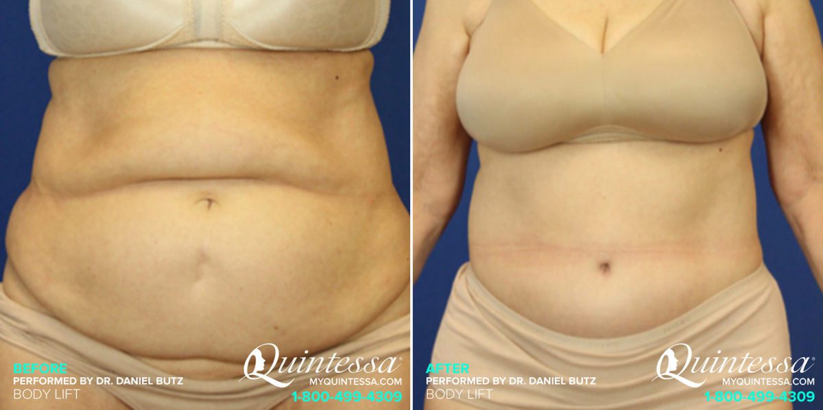Body Lift Before and After Photos in Delafield, WI, Patient 17429