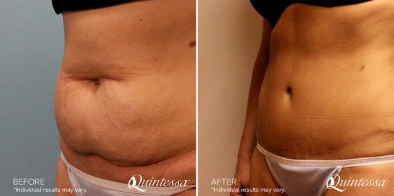Tummy Tuck Before and After Photos in Delafield, WI, Patient 17433