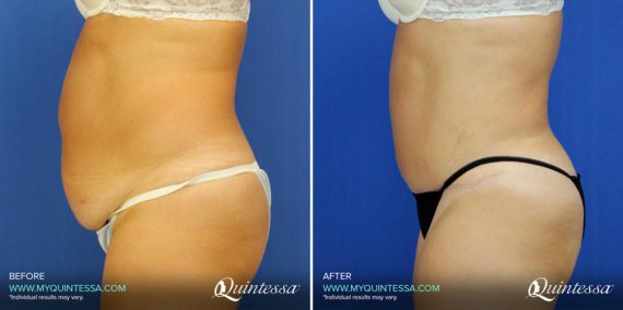 Tummy Tuck Before and After Photos in Delafield, WI, Patient 17438
