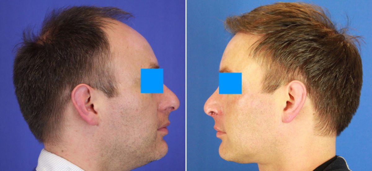 Hair Restoration Before and After Photos in Delafield, WI, Patient 17446