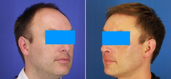 Hair Restoration Before and After Photos in Delafield, WI, Patient 17446