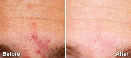 BBL Laser Facial Before and After Photos in Delafield, WI, Patient 17456