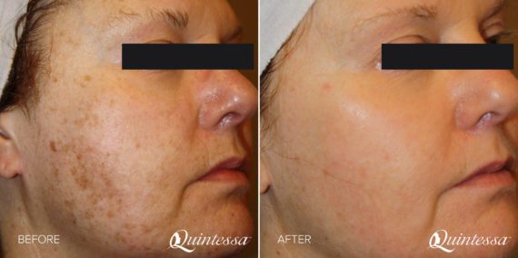 BBL Laser Facial Before and After Photos in Delafield, WI, Patient 17460