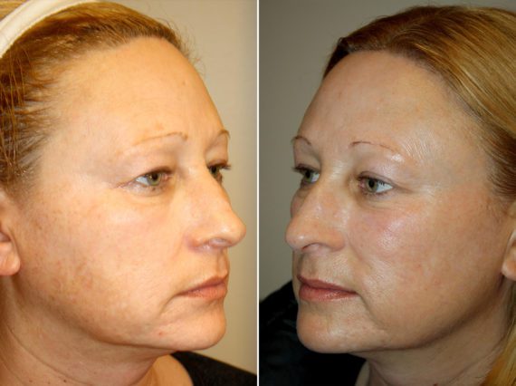 BBL Laser Facial Before and After Photos in Madison, WI, Patient 17464