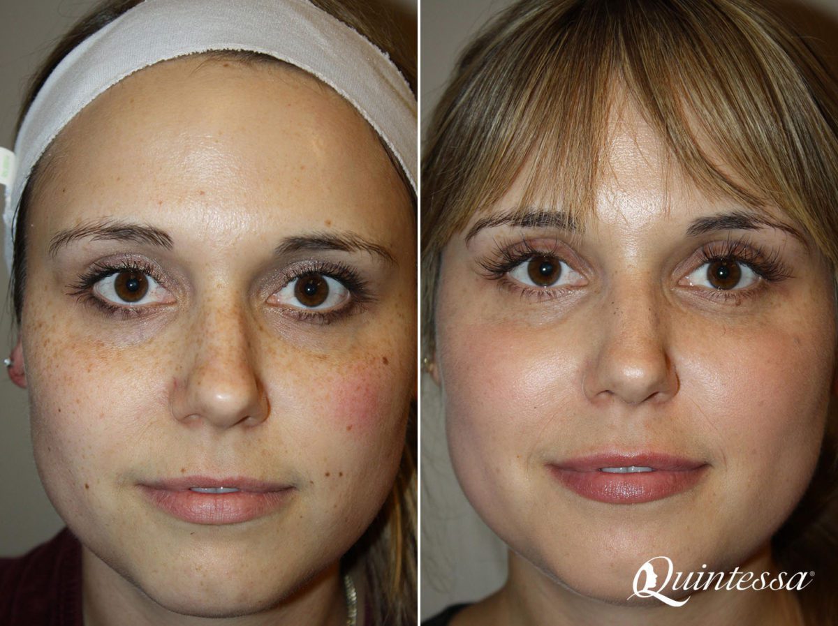 BBL Laser Facial Before and After Photos in Madison, WI, Patient 17468