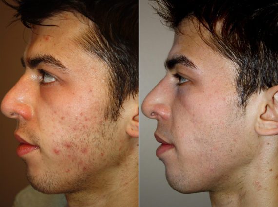 BBL Laser Facial Before and After Photos in Madison, WI, Patient 17472