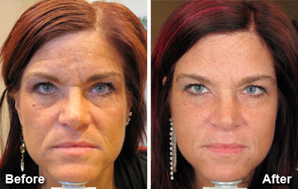 Botox Before and After Photos in Delafield, WI, Patient 17477
