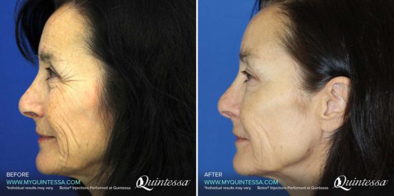 Botox Before and After Photos in Delafield, WI, Patient 17481