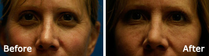 Fillers Before and After Photos in Delafield, WI, Patient 17498