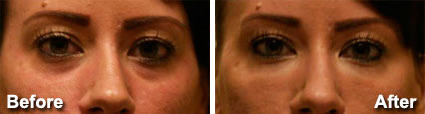 Fillers Before and After Photos in Delafield, WI, Patient 17502