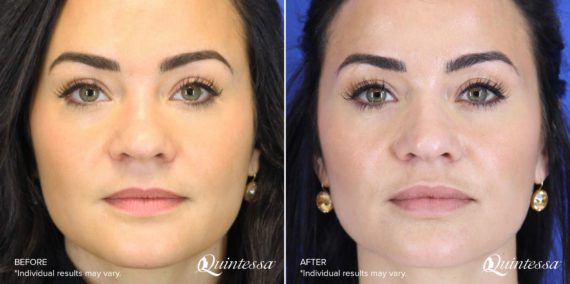 Fillers Before and After Photos in Delafield, WI, Patient 17506