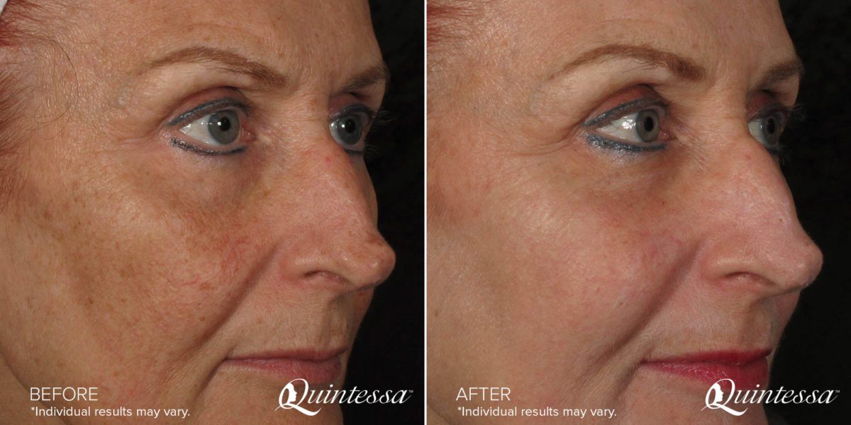 Halo Laser Before and After Photos in Delafield, WI, Patient 17510
