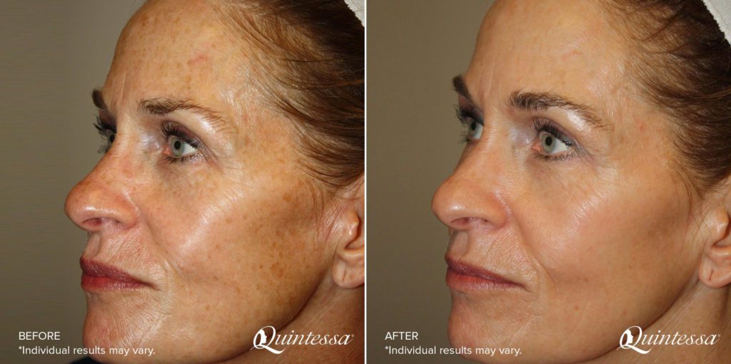 Halo Laser Photos Milwaukee & Madison