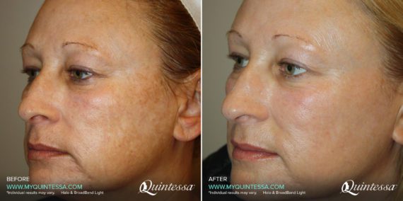 Halo Laser Before and After Photos in Delafield, WI, Patient 17518