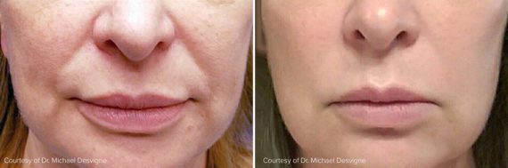 Thread Lift Before and After Photos in Mequon, WI, Patient 17522
